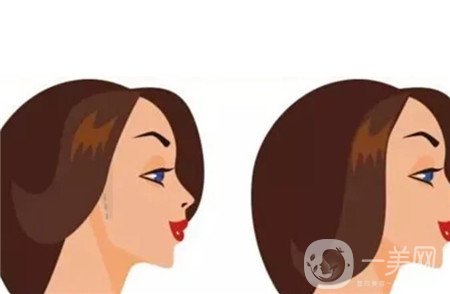 颧骨内推+下颌角切除手术真实感受记录，*果图大分享