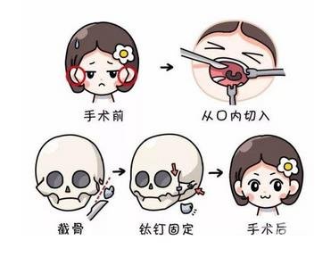 下颌角整形100天真人案例，巴掌小脸轻松get！