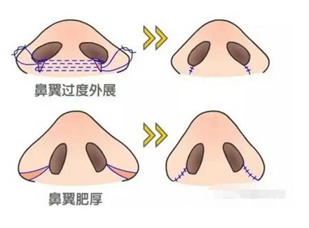 北京鼻部手术整形手术恢复过程大反馈