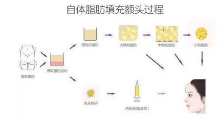 上海全脸自体脂肪填充打造精致脸型，果图大分享