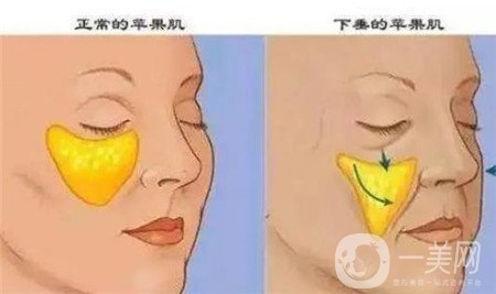 上海全脸自体脂肪填充打造精致脸型，*果图大分享