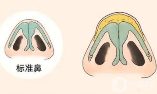 上海九院肋软骨隆鼻恢复日志分享：鼻子自然到朋友都看不出是做的