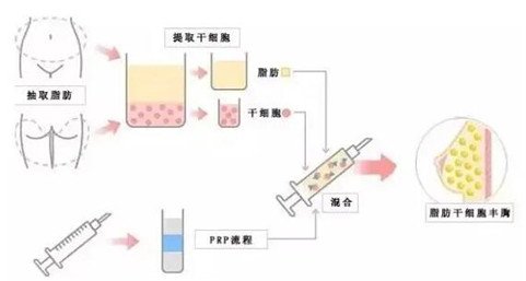 云南华美杨继红玻尿酸丰面颊真人日记曝光