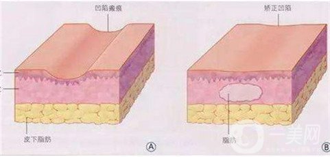 广州韩妃整形陈坦自体脂肪填充面部术后恢复图来了