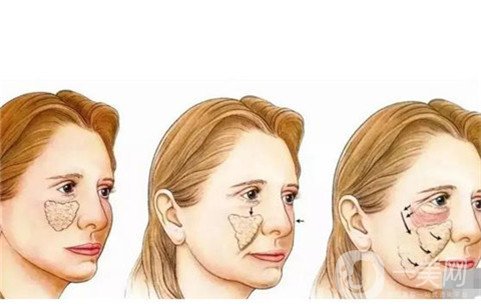 成都美极徐勇自体脂肪填充全脸术后果图分享