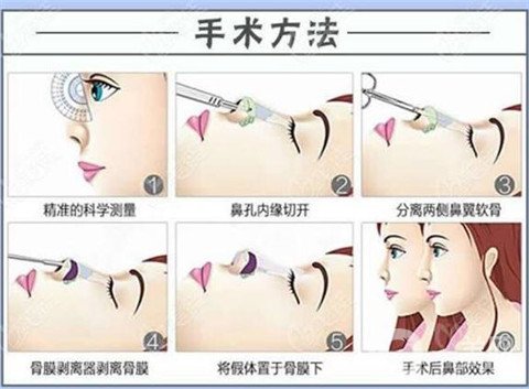 长沙丽都谭骛远硅胶隆鼻术前术后图