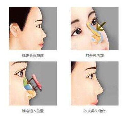 合肥华美彭绍宗做的假体隆鼻，恢复三个月的照片分享
