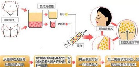 上海时光整形何晋龙自体脂肪全脸填充术后反馈