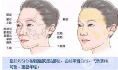 上海首尔丽格麻生泰自体脂肪全脸填充真人恢复过程图，轻松整出高级感