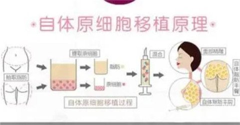 上海首尔丽格唐鏖自体脂肪填充全脸恢复记录，网红套餐整形