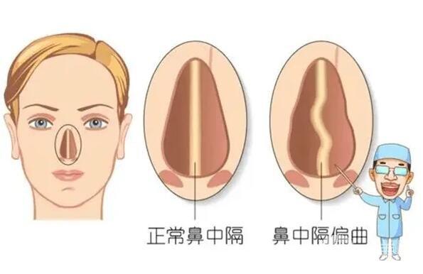 北京世熙宋玉龙鼻部手术整形手术案例恢复过程图分享