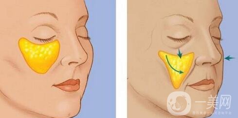 玻尿酸填充苹果肌真人日记分享
