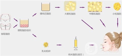 玻尿酸填充苹果肌真人日记分享