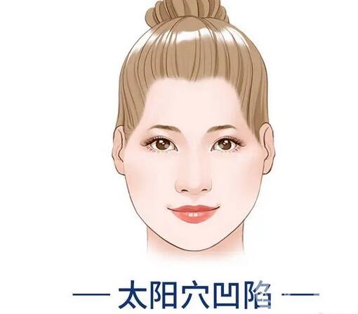自体脂肪填充太阳穴术后果展示_图片