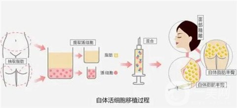 自体脂肪填充太阳穴术后*果展示_图片