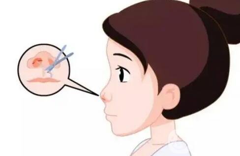 肋软骨隆鼻术前术后图片【过程分享】