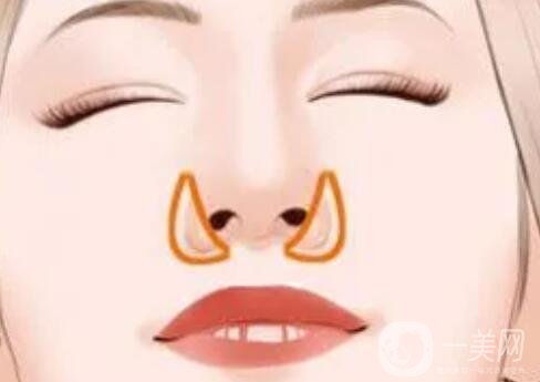 【膨体隆鼻+鼻翼缩小】鼻部手术整形术后分享