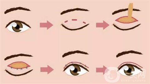 *整形过程及术后日记分享