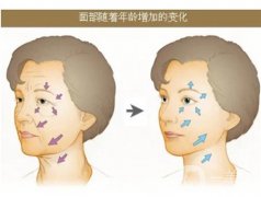 悬吊提升除皱手术有什么优点