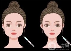 自体细胞注射除皱有哪些优势