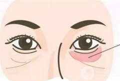 激光去除黑眼圈手术的危害有哪些