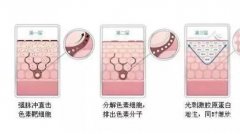 激光祛痘印什么时候有效，激光祛痘什么时候有效