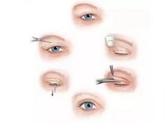 开眼角有哪些风险以及术后如何护理