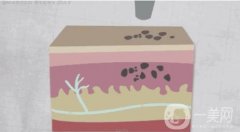 激光去除胎记的原理是什么，有哪些危害