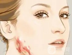 点阵激光祛疤有哪些优点，多长时间可以看见效果