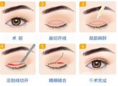 疤痕体质可以割双眼皮吗，效果是永久的吗