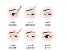 什么是埋线双眼皮?哪些人适合做埋线双眼皮