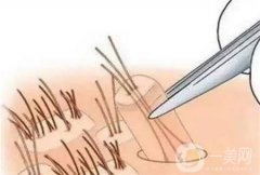 仿生眉毛种植的方法及特点是什么