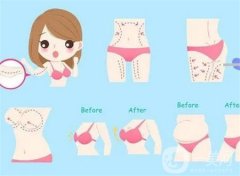 大腿抽脂术后应该穿多久的塑身衣?