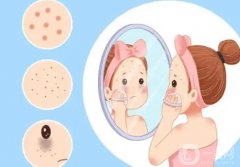 激光祛痘的原理是什么痕?效果如何