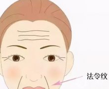 自体脂肪填充法令纹有效果吗