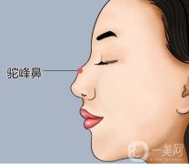 驼峰鼻矫正价格受哪些因素影响