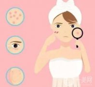 黑脸娃娃祛痘怎么样?适合哪些人