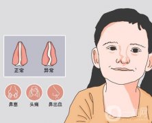 鼻中隔偏曲有哪些症状，需要手术吗
