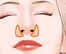 鼻翼缩小手术失败如何修复