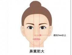 鼻基底填充有哪些后遗症?