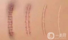 烧伤疤痕去除的方法有哪些?