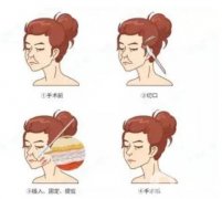 射频紧肤效果能持续多久，有副作用吗?