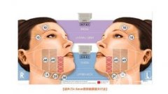 热玛吉有效果吗，热玛吉有什么特点