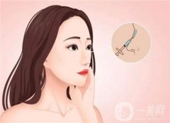 延长鼻小柱有什么原理，延长鼻小柱时应注意什么