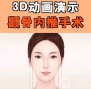 颧骨内推好还是磨颧骨好？颧骨内推与磨颧骨哪个更安全？