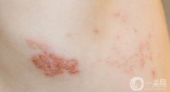 激光祛疤痕修复效果怎么样？多少钱？附新价目表一览