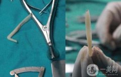 鼻子假体取出恢复图片分享！鼻子取出假体还和以前一样吗？解答查收