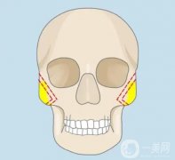 颧骨内推手术多少钱？风险高吗？新收费价格标准分享