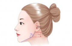 下颌角磨骨手术需要多少钱？手术风险大吗？真实案例恢复过程参考