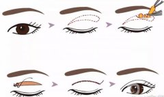 双眼皮埋线过程图揭晓，价格解析及注意事项更新